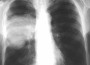 cancer pulmonar