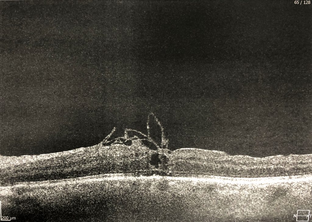 RetinaTomogram 1